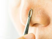 Kapalı Komedon Nasıl Geçer?