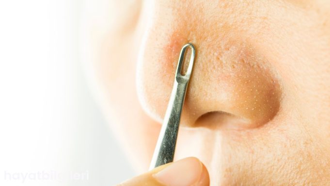 kapali-komedon-nasil-gecer