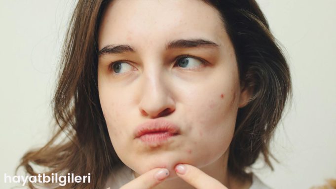 sivilce-izleri-icin-dogal-yontemler