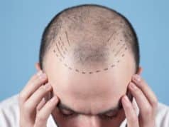How Hair Transplant Methods and Techniques Are Evaluated in Modern Practice?