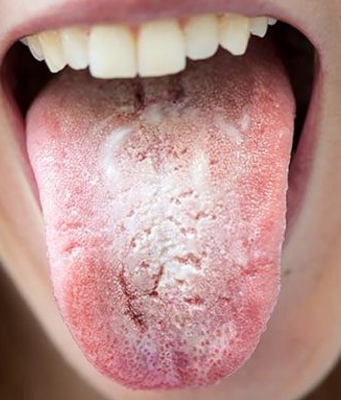 Ağız Kuruluğu Neden Olur? Bilinmesi Gerekenler!